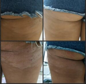 טיפול טבעי באטופיק דרמטיטיס באמצעות דיקור סיני