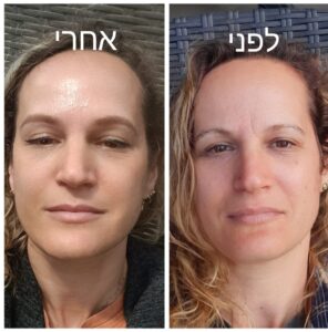 לפני ואחרי דיקור קוסמטי